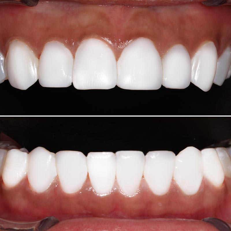 کامپوزیت ونیر در سعادت آباد